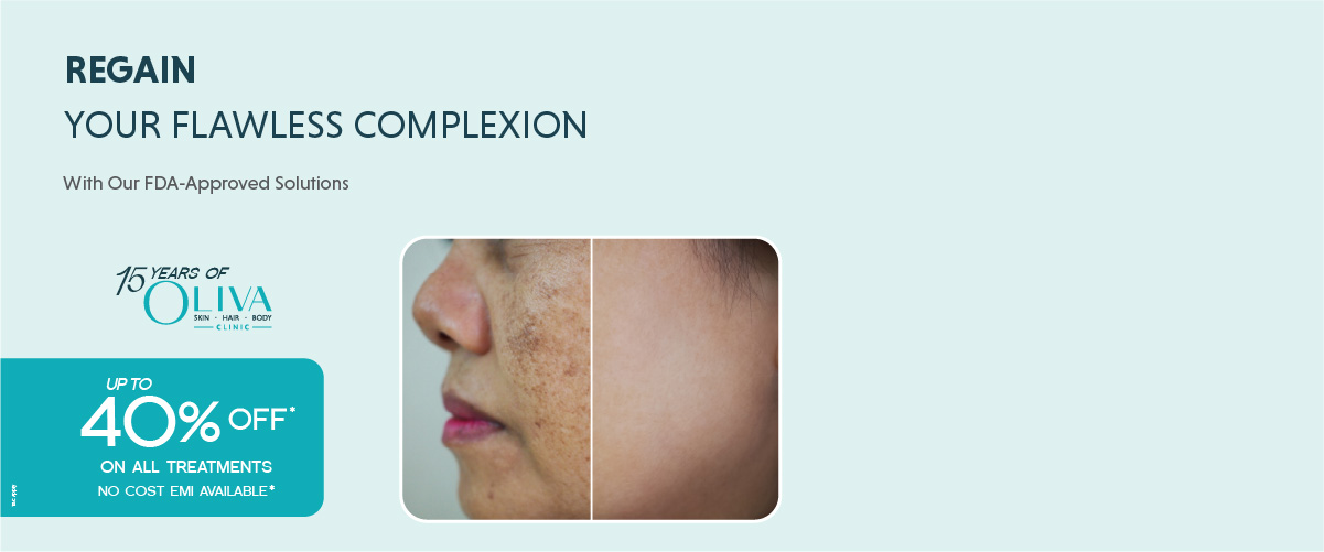 melasma treatment in bangalore