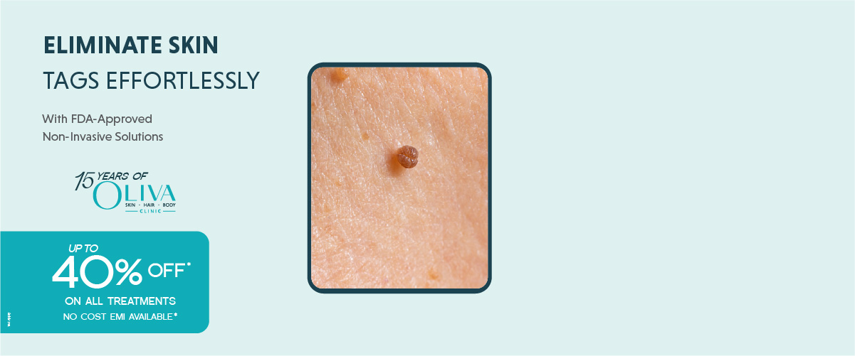 skin tag removal