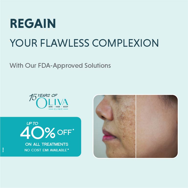 melasma treatment