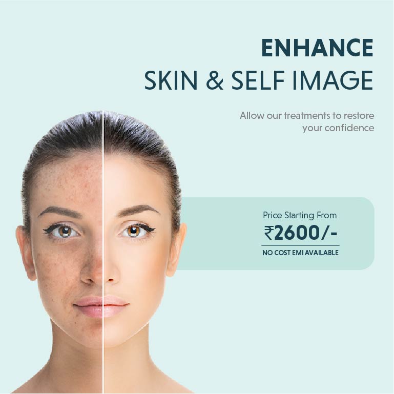 pigmentation treatment in kochi