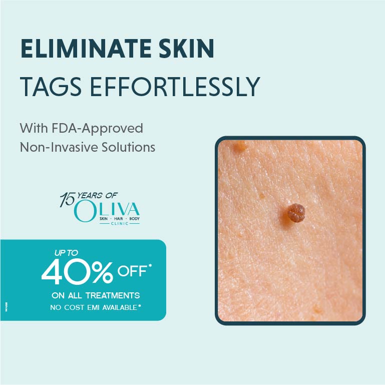 skin tag removal