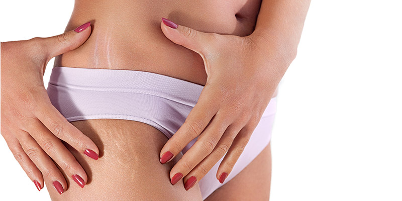 How to deal with stretch marks in teenagers, according to a dermatologist