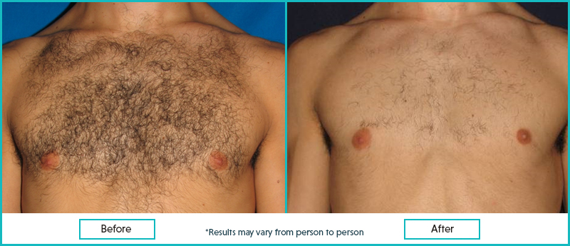 Men Hair Removal Tips Waxing and Laser
