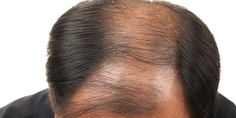 female pattern baldness crown