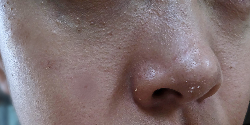 clogged pores all over face