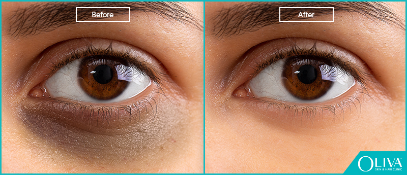 Blepharoplasty Cost In India  Best Eyelid Surgery Venkat Center