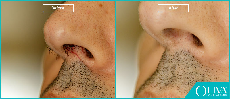 laser hair removal inside nose