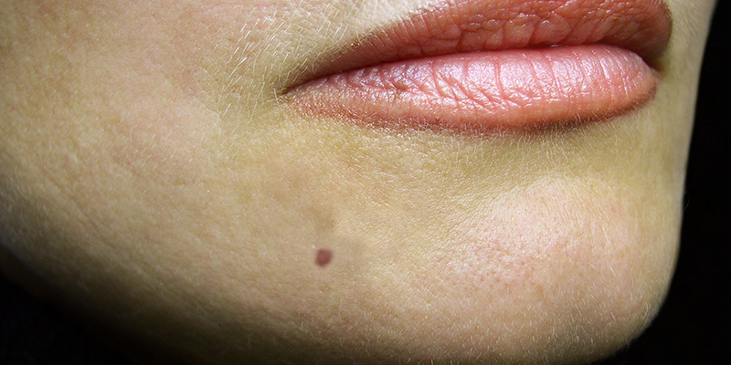 How to remove moles from face permanently