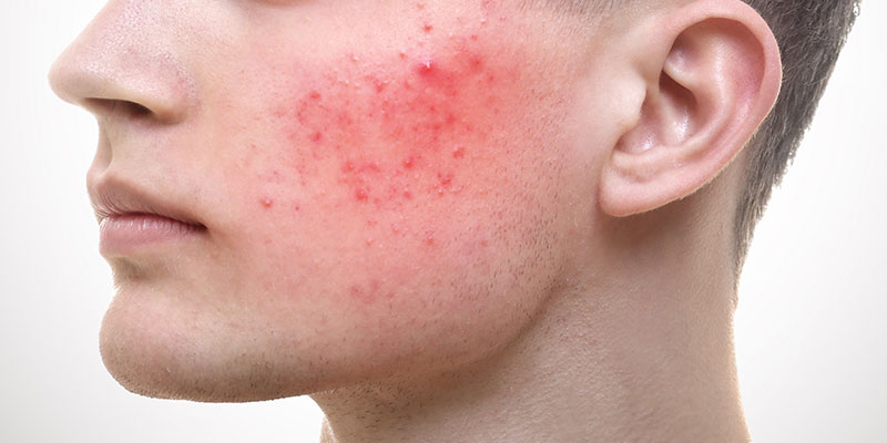 acne rosacea vs acne vulgaris