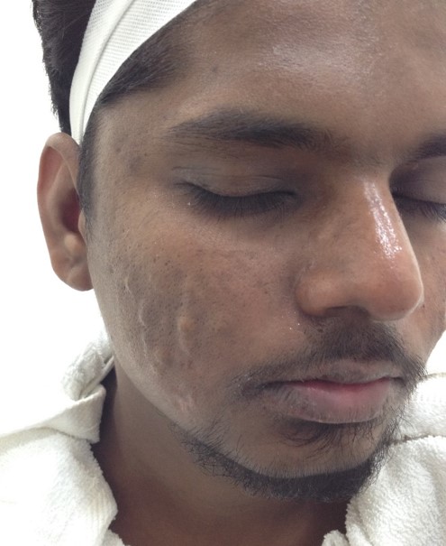 Acne treatment After - Gopinath @olivaclinic