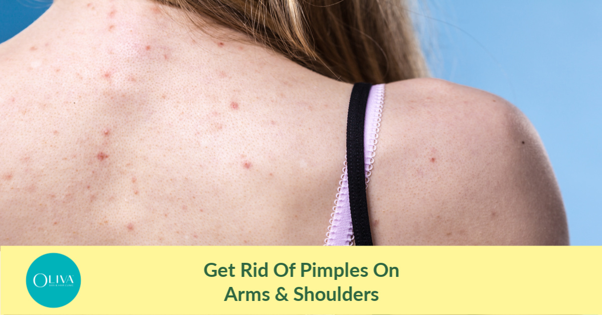 How To Remove Pimples From Arms Shoulders 