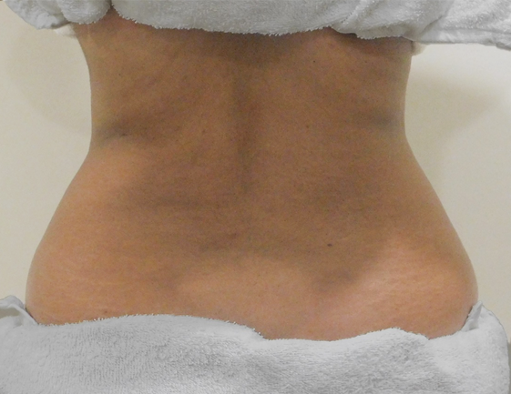 Liposuction Rf Cavitation Slimming Machine, For Clinical Purpose at Rs  25000 in New Delhi
