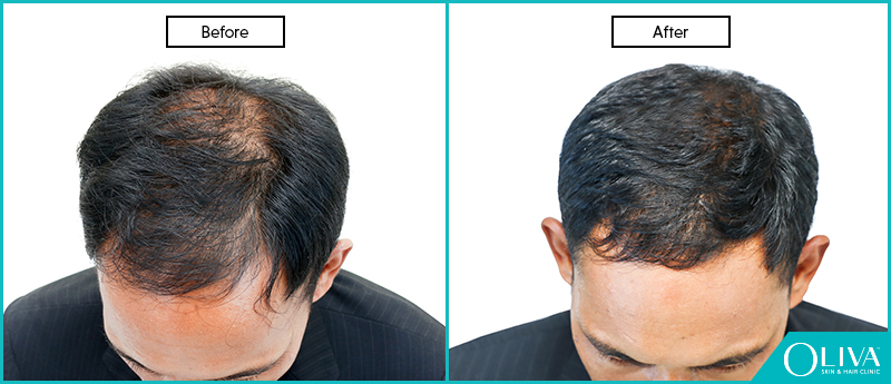 PRP Hair Loss Therapy