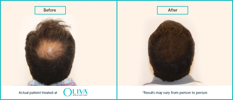 prp-hair-treatment-results[1]