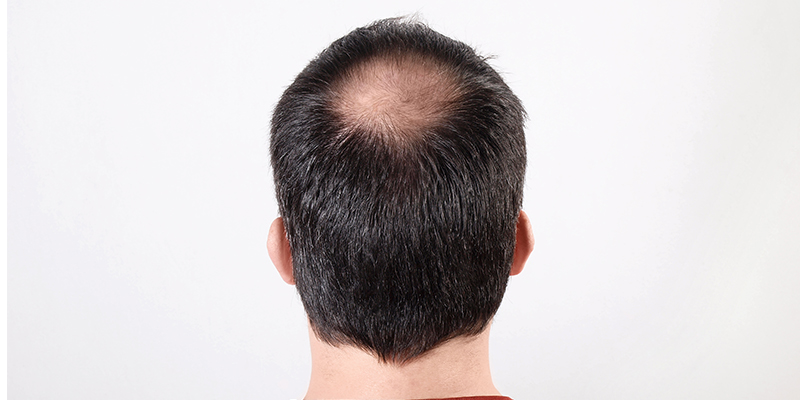 Alopecia (Hair Loss): Common Causes & Management Options