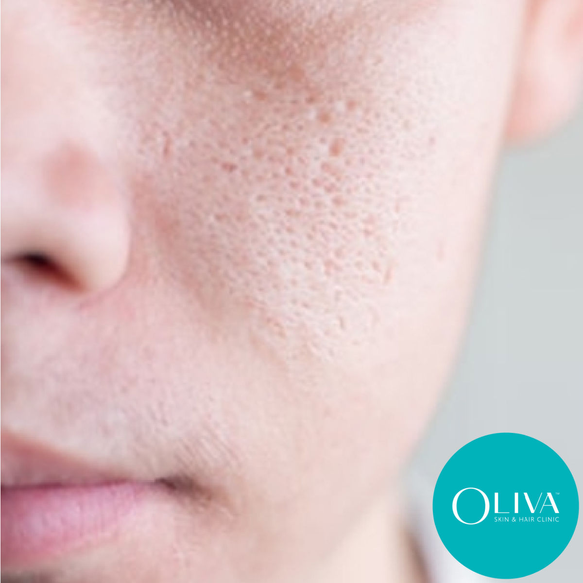 Open Pores Causes Treatments Results Prevention Tips