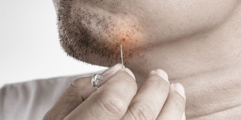 How To Get Rid Of Ingrown Hair: Best Treatments And Preventions