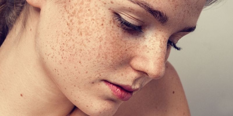 Freckles: What They Are, vs. Moles, Causes & Removal