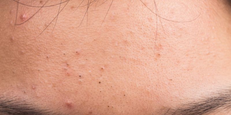 Sweat Pimples Causes Treatments Prevention Tips