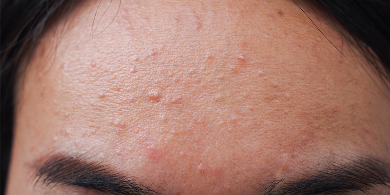 Acne Keloidalis Nuchae Condition Treatments and Pictures for Teens   Skinsight