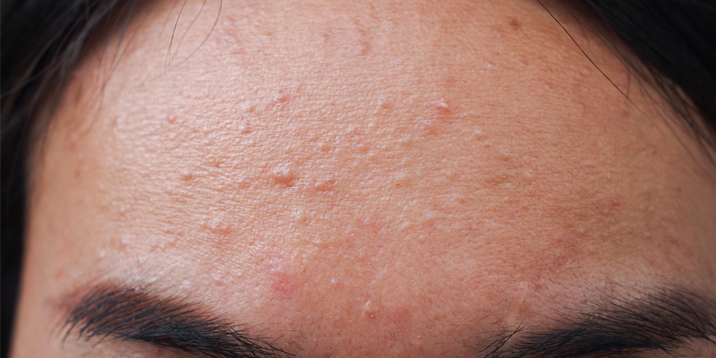 Fungal Acne Causes Symptoms Treatments Prevention