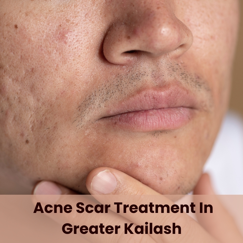 Acne Scar Treatment In Greater Kailash