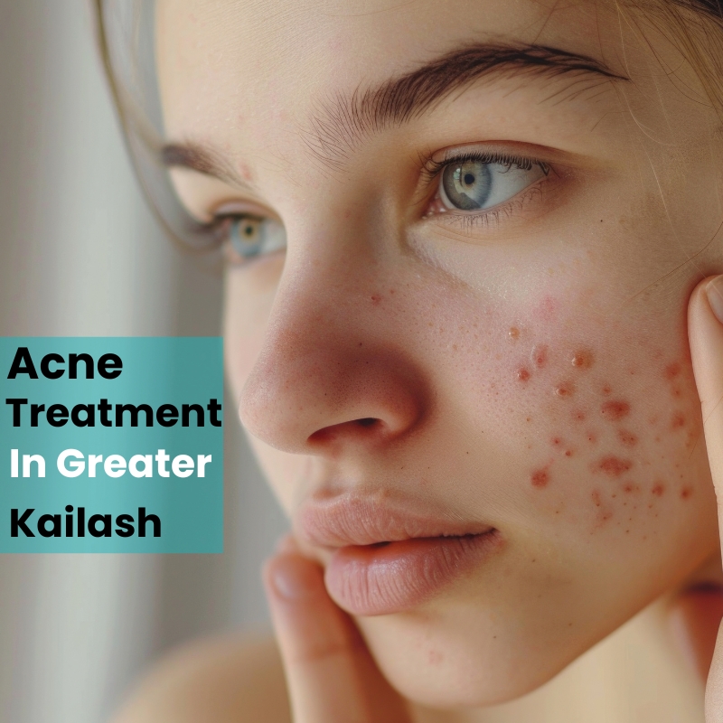 Acne-Treatment-In-Greater-Kailash