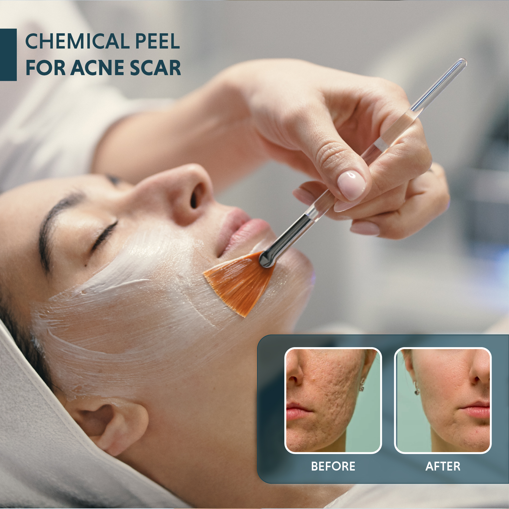 Chemical Peel For Acne Scars