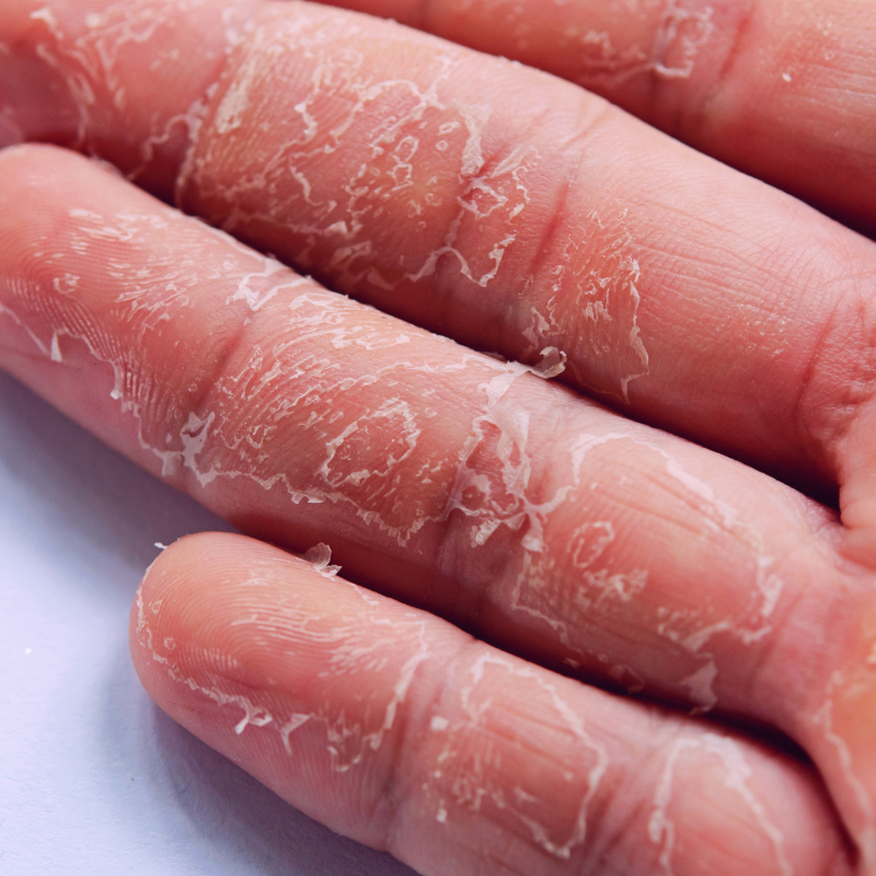 Skin Peeling On Fingers