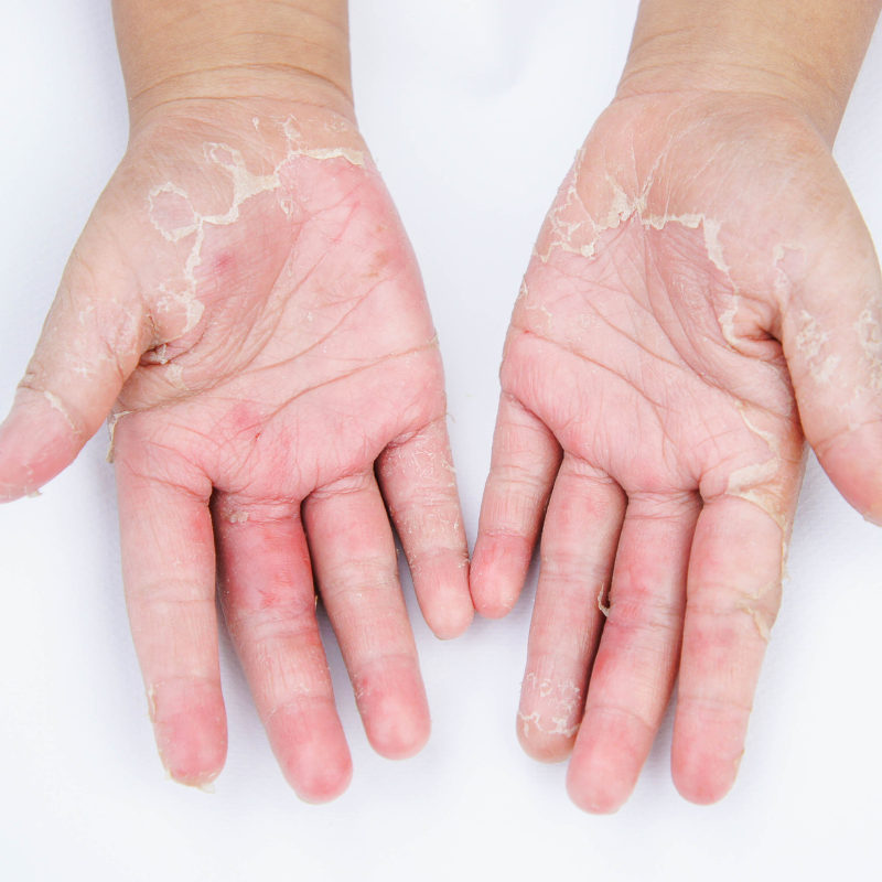 Skin Peeling On Hands