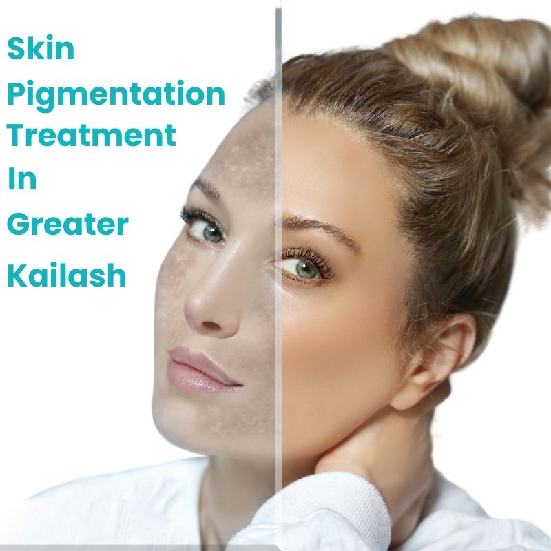 Skin-Pigmentation-Treatemtent-In-Greater-Kailash