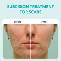 Subcision Treatment For Acne Scars