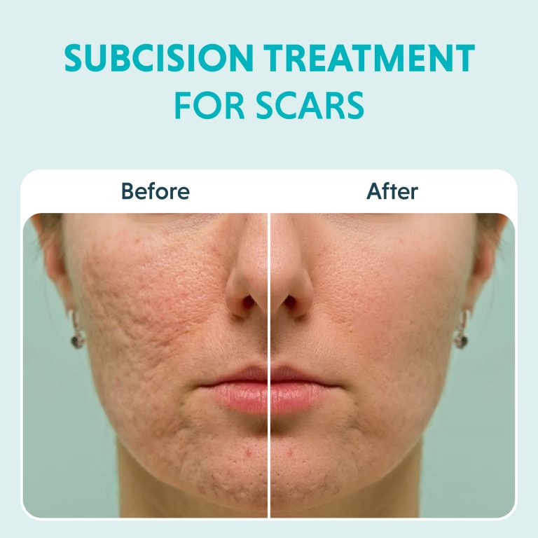 Subcision Treatment For Acne Scars