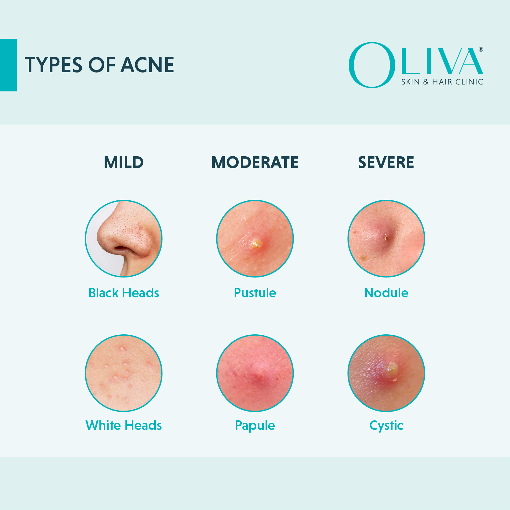 Types-of-Acne