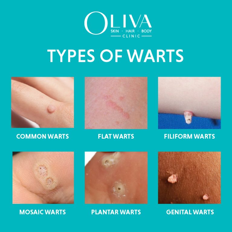 Types of Warts