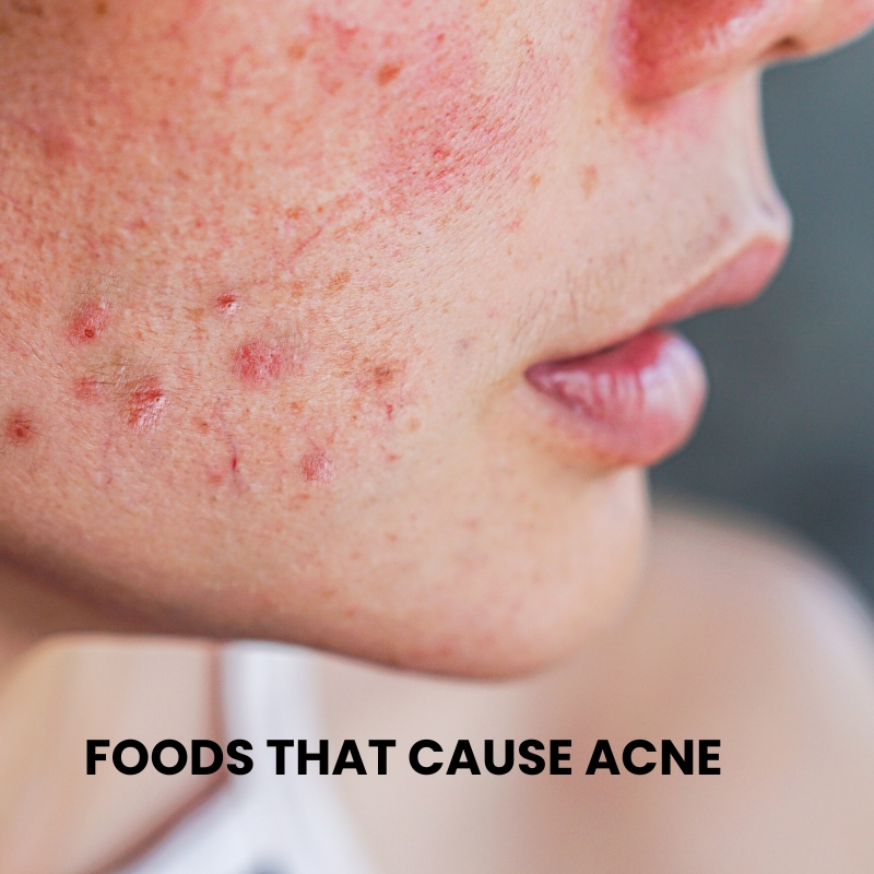 Foods That Cause Pimples: Know What Foods To Avoid For Acne