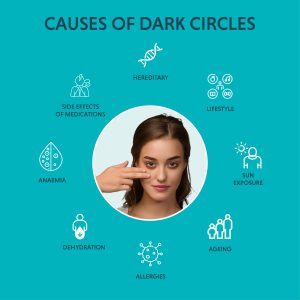 What Causes Dark Circles Under Eyes