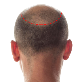 Hair Transplant Treatment