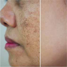 Melasma Treatment