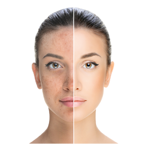 Pigmentation Treatment