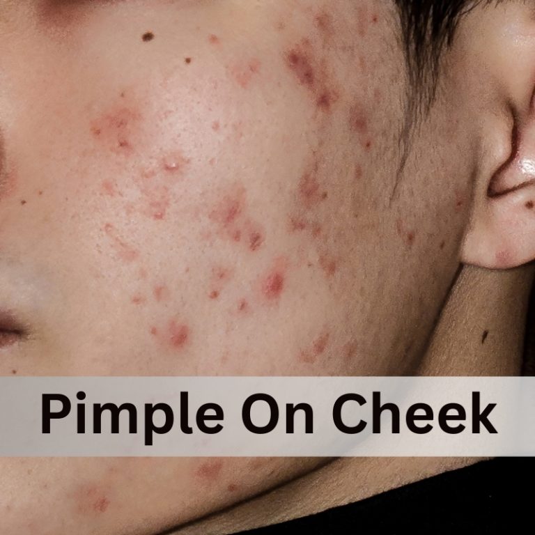 pimples on the cheeks