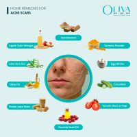 home remedies for acne scars