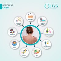 Body-Acne-Causes