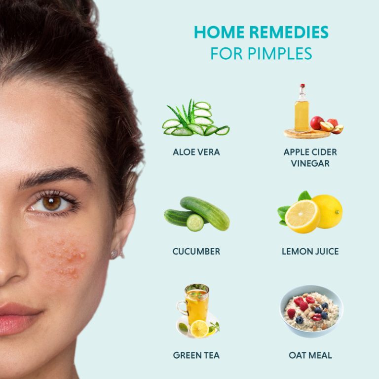 Home-Remedies-For-Pimples