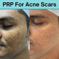 PRP-For-Acne-Scars.