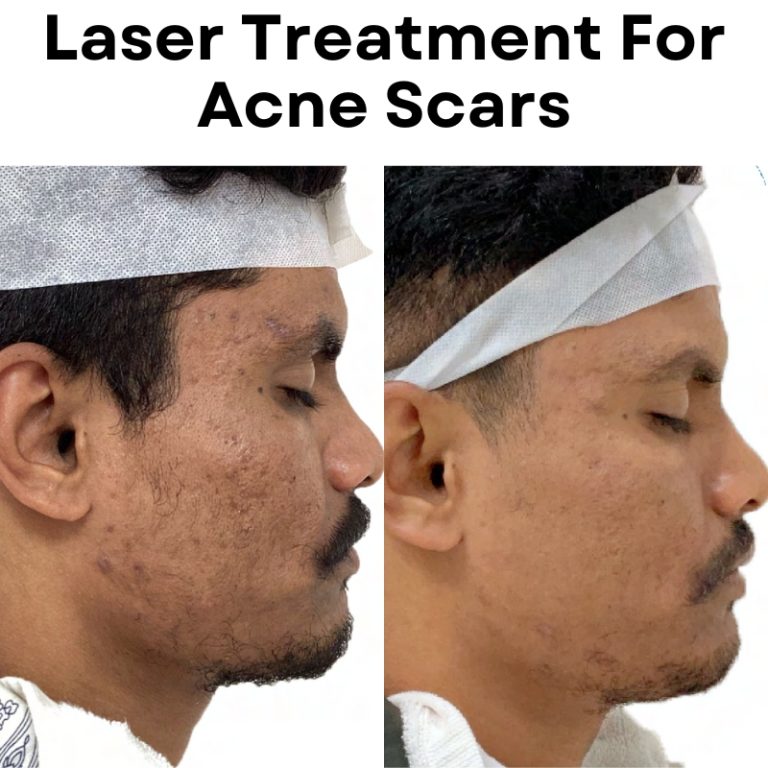 laser treatment for acne scars