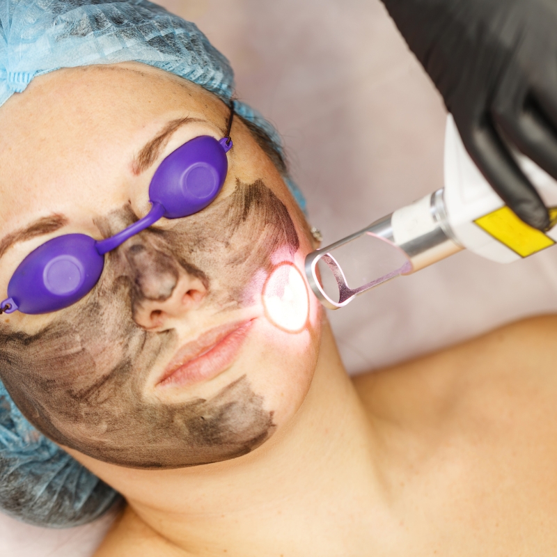 Q Switch Laser Treatment In India: Cost, Benefits, Side Effects