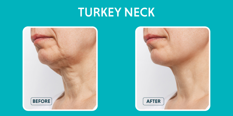 Turkey Neck: Exercises, Treatments & Surgeries to Get Rid of It