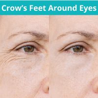 crow's feet around eyes