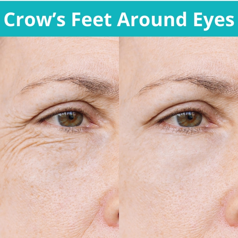 crow's feet around eyes